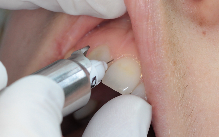 Painless dental injections